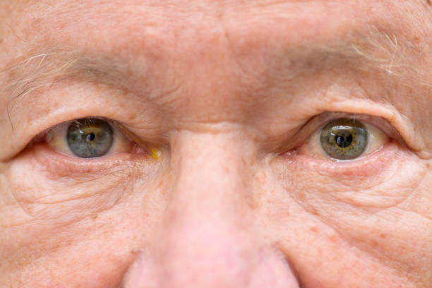 istock Elderly man suffering from anisocoria showing unequal pupils 1335122925