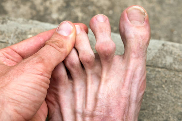 Swollen joint on the foot stock photo