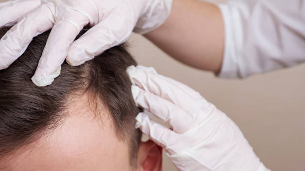 trabajador médico con guantes examina la cabeza de un hombre calvo de cerca - cabello humano fotografías e imágenes de stock