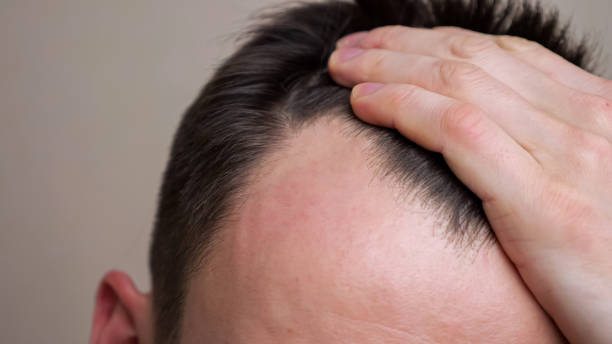 Young man examines his bald spots in the mirror Young man examines his bald spots in the mirror. balding stock pictures, royalty-free photos & images