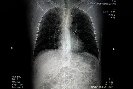 Computed tomography of chest organs. CT scan.