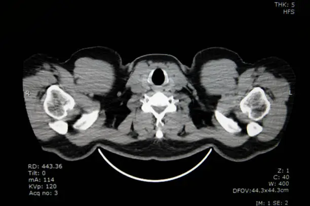 Photo of Computed tomography of chest organs. CT scan.