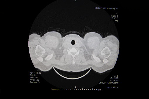 Computed tomography of chest organs. CT scan. CT Abdomen Cross section View.