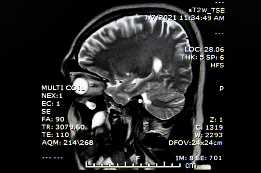 Magnetic resonance images of the brain (MRI brain). Computed resonance imaging of the human brain.