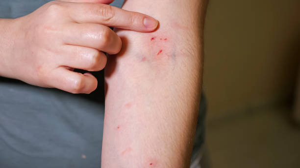 istock Woman points out scratches and bites on her arm 1335803505