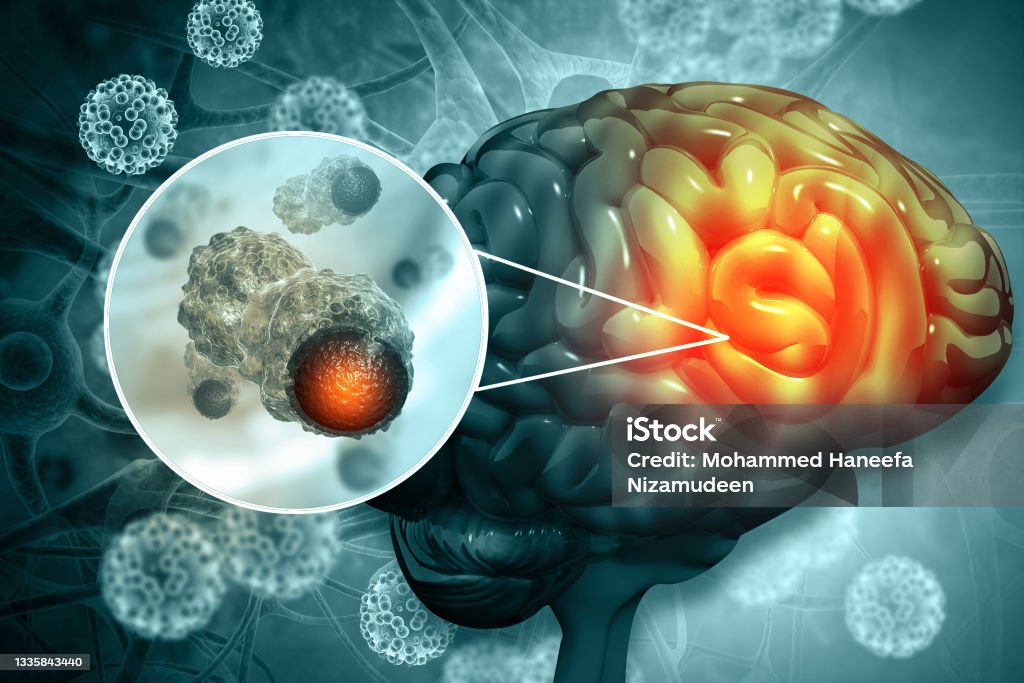 Brain cancer, showing presence of tumor inside brain. 3d illustration Brain Tumour Stock Photo