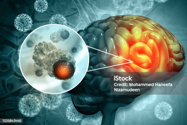Brain Cancer Showing Presence Of Tumor Inside Brain 3d Illustration Stock Photo - Download Image Now