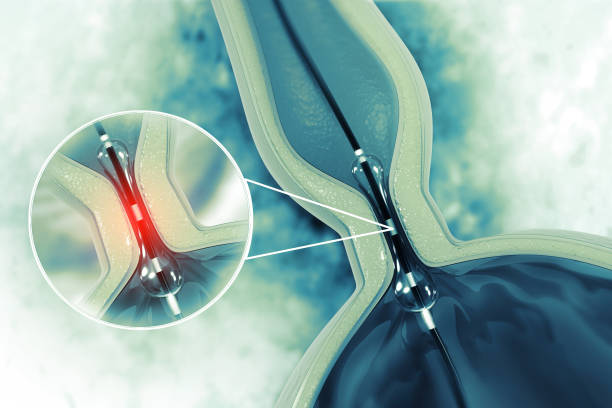 procedimiento de angioplastia con balón con stent en vena. ilustración 3d - angioplasty fotografías e imágenes de stock