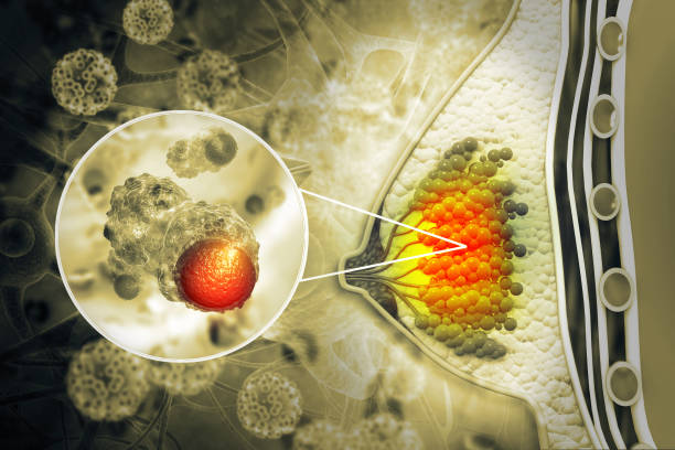 female breast with cancer focus of inflammation. 3d illustration - physical checkup imagens e fotografias de stock