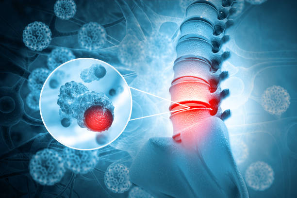 cáncer de columna vertebral o enfermedad tumoral espinal.3d ilustración - columna fotografías e imágenes de stock