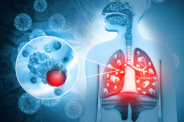 폐암 진단 및 인간 폐 질환. 3d 일러스트레이션 - human lung asthmatic x ray human internal organ 뉴스 사진 이미지