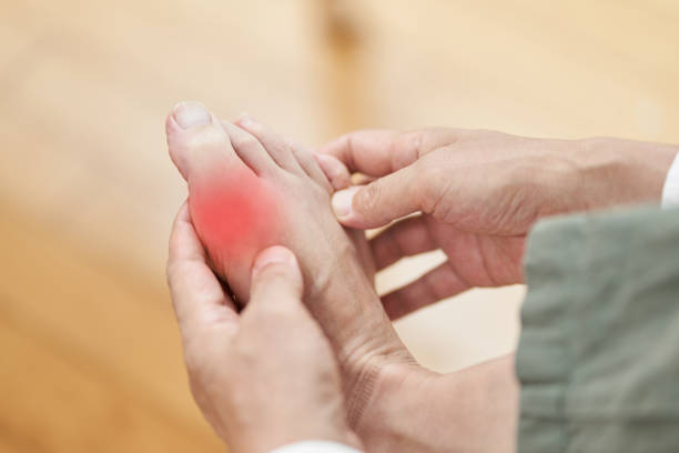 the feet of a man suffering from gout - on his toes imagens e fotografias de stock