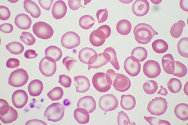 células-alvo com glóbulos vermelhos anormais na mancha de sangue - célula alfa - fotografias e filmes do acervo