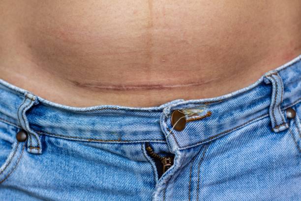 cicatriz en el abdomen de una mujer que tuvo una cesárea. - cesarean fotografías e imágenes de stock