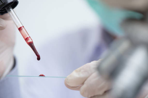 Blood exam Doctor or lab technician dripping red blood on slide glass for malaria test, blood group test, complete blood count (CBC) with microscope in hospital laboratory. close up malaria blood sample stock pictures, royalty-free photos & images