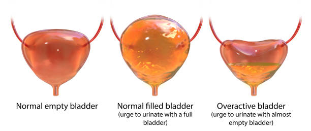 Overactive bladder. Urinary bladder empty, normal full, and overactive stock photo