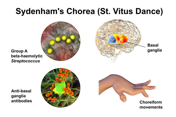 sydenham's chorea, an autoimmune disease that results from childhood infection with streptococcus bacteria - corpus striatum imagens e fotografias de stock