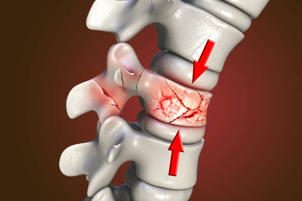 fracture de la colonne vertébrale, lésion vertébrale traumatique, illustration - dégénératif photos et images de collection