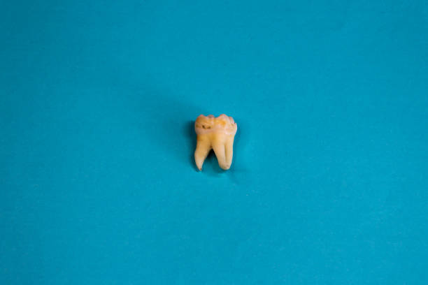 istock Extracted wisdom tooth on on blue background, close up 1336056910