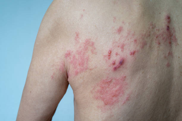 Herpes Zoster Herpes Zoster shingles stock pictures, royalty-free photos & images