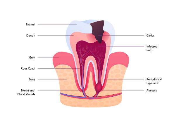 Tooth Decay Line Graph Tooth anatomy decay chart
