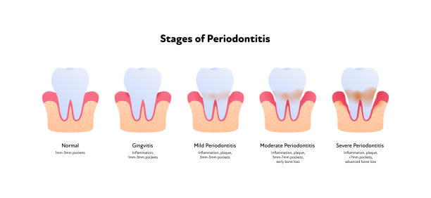 ilustrações de stock, clip art, desenhos animados e ícones de tooth anatomy and decay chart. vector biomedical illustration. side view. stages of teeth periodontitis illness isolated on white background. design for healthcare, dentistry - human teeth dental hygiene anatomy diagram
