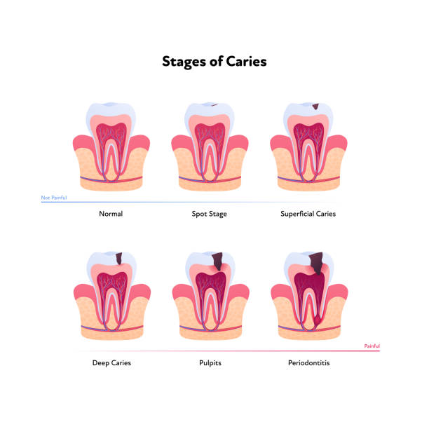 ilustrações de stock, clip art, desenhos animados e ícones de tooth anatomy and decay chart. vector biomedical illustration. cross section. stages of teeth caries isolated on white background. design for healthcare, dentistry - human teeth dental hygiene anatomy diagram