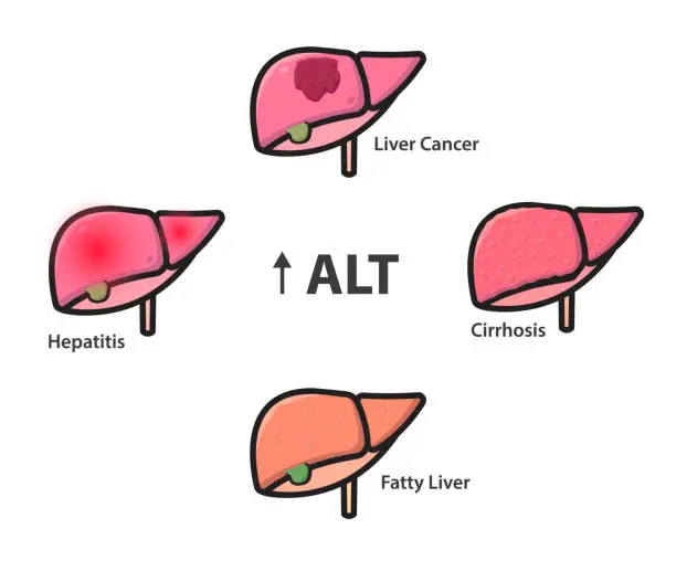 Vector illustration of liver conditions common causes of the high level of ALT in a blood