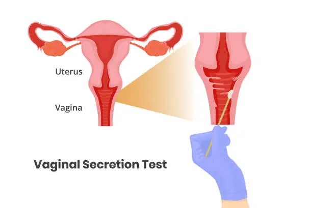 Vector illustration of Vaginal secretion test. Vaginal swab vecor illustration.