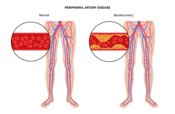 Peripheral artery disease PAD Peripheral artery disease. Ischemia in leg. Cholesterol in human blood vessel. PAD concept. Fat cells in vein artery. Blocked vascular in man body. Medical poster for clinic flat vector illustration clogged artery stock illustrations