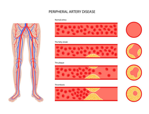 Peripheral artery disease PAD Peripheral artery disease. Ischemia in leg. Cholesterol in human blood vessel. PAD concept. Fat cells in vein artery. Blocked vascular in man body. Medical poster for clinic flat vector illustration clogged artery stock illustrations