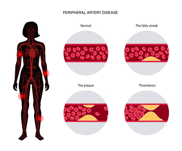 illustrazioni stock, clip art, cartoni animati e icone di tendenza di malattia dell'arteria periferica pad - human limb