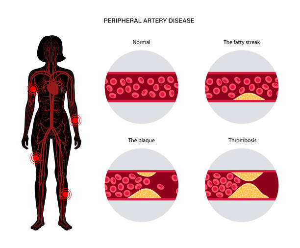 Peripheral artery disease PAD Peripheral artery disease. Ischemia in legs and hands. Cholesterol in human blood vessel. PAD concept. Fat cells in vein artery. Blocked vascular in woman body. Medical poster flat vector illustration human limb stock illustrations