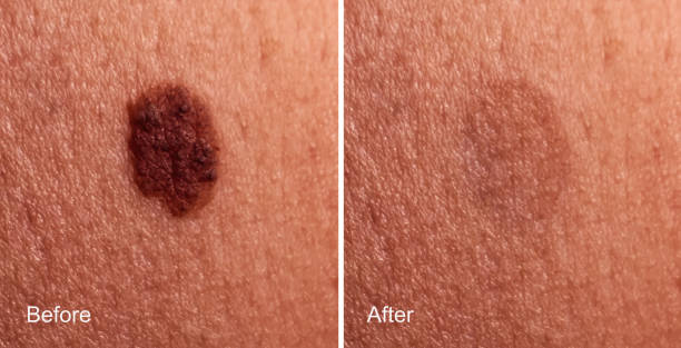 Photo Before and After removal of large mole on woman's skin. Mole removal concept Photo before and after removal of large mole on woman's skin. Mole removal concept word cloud photos stock pictures, royalty-free photos & images