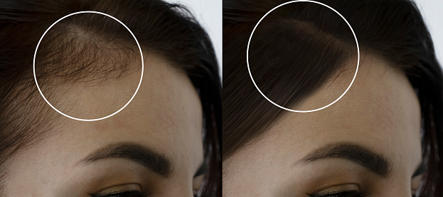 calvicie de la cabeza de la mujer antes y después del tratamiento photo