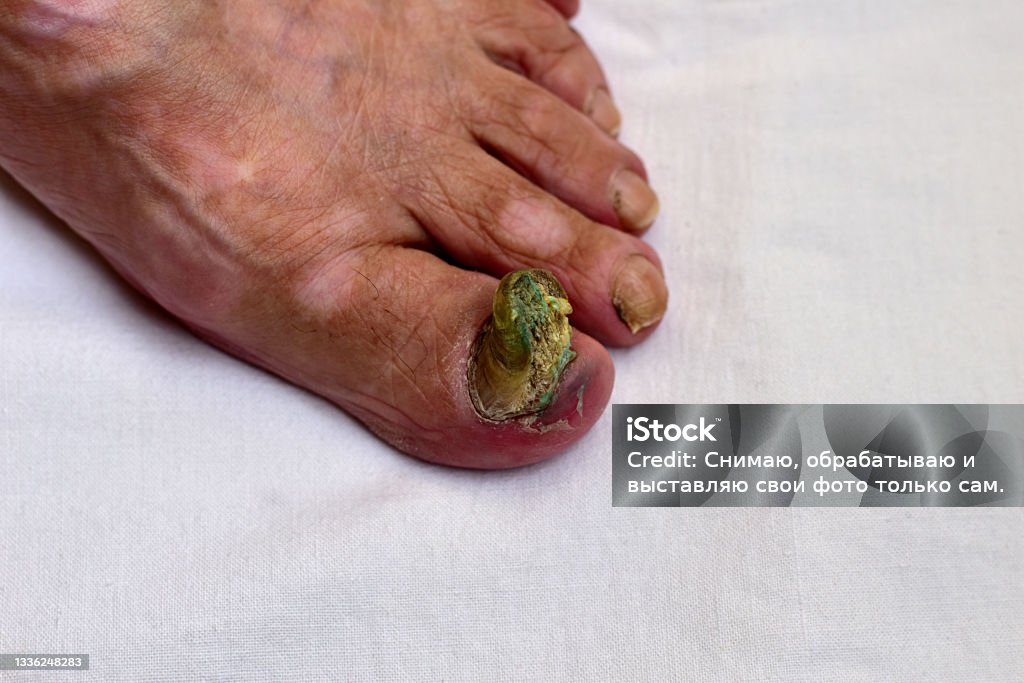 Fungal damage to the nail of the right foot, side view. The photo shows a close-up of the right foot with a fungal growth on the toenail. Orthopedist Stock Photo
