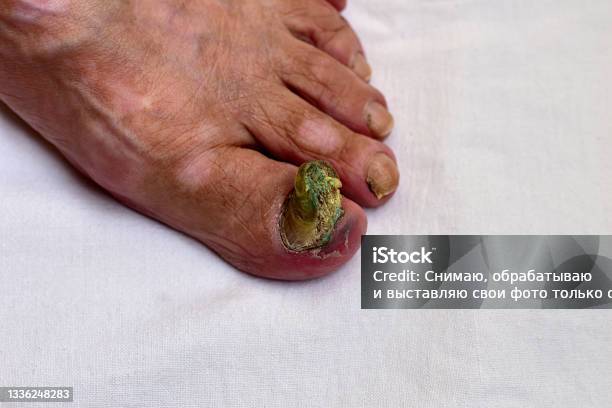 Fungal Damage To The Nail Of The Right Foot Side View Stock Photo - Download Image Now