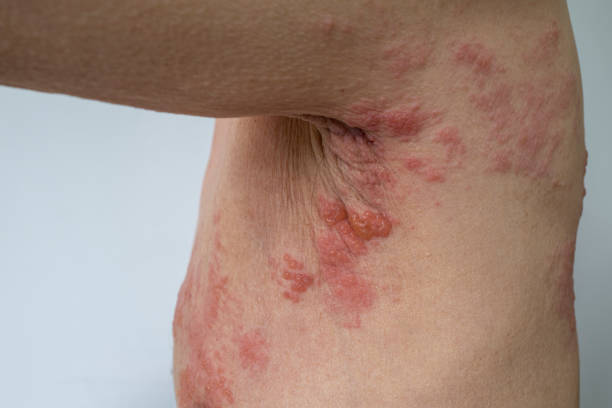 herpes zoster, gürtelrose - zoster stock-fotos und bilder