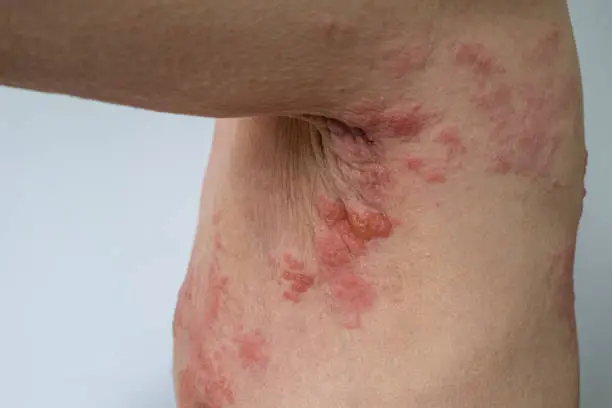Herpes Zoster,Shingles