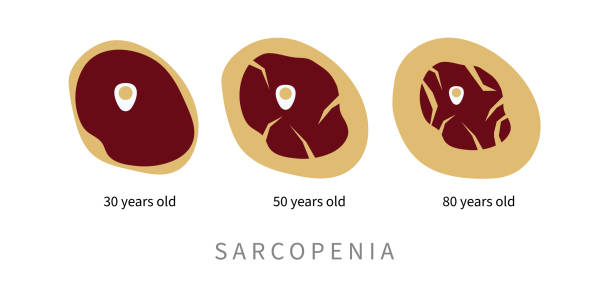 Sarcopenia in elderly. Replacement of muscle tissue Sarcopenia in elderly. Replacement of muscle tissue with fat in aging process. Vector illustration atrophy stock illustrations