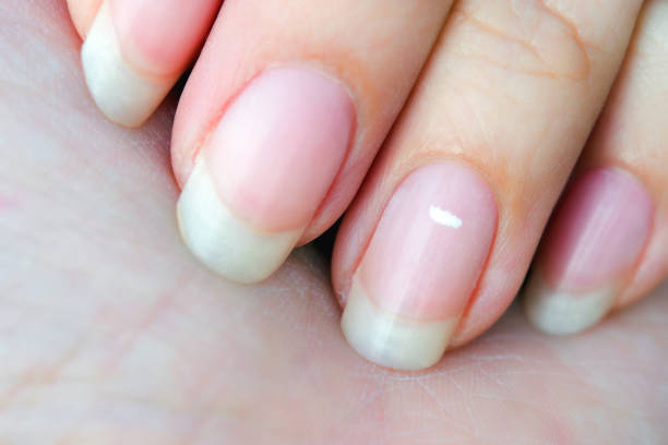 白い斑点をクローズアップするか、指の爪にダニ。ほとんどが軽傷の結果であった。この病気はロイコニキアと呼ばれています。 - 手の爪 ストックフォトと画像