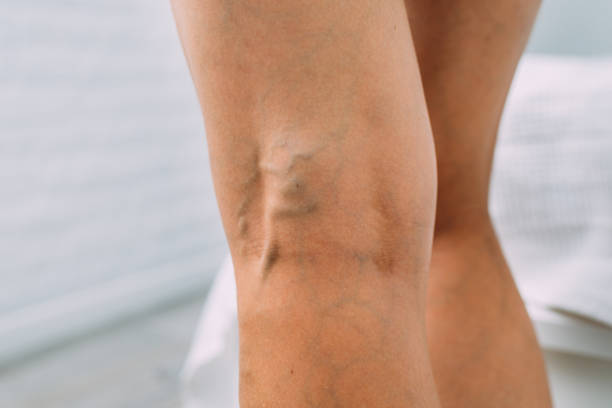 legs with woman with varicose veins and pronounced mesh - woman legs veins stockfoto's en -beelden