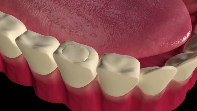 7,942 Tooth Decay Stock Videos and Royalty-Free Footage - iStock | Tooth  pain, Bad teeth, Gum disease