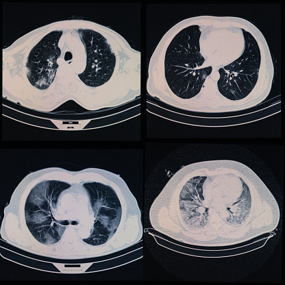CT of thorax of four patients having covid-19 disease. Four variations are seen on four lung x-ray images. Shot with a full frame mirrorless camera.