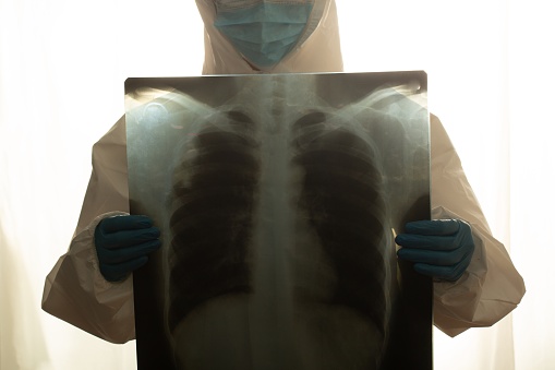 Doctor holding x-ray film examining lungs and ribs