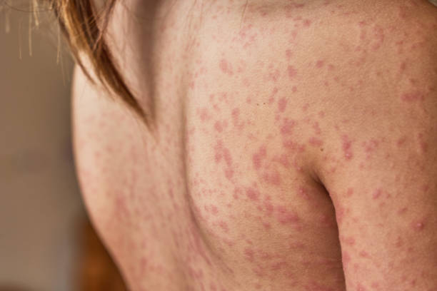 allergic rash on the body of the patient. 5 year old girl. Caused by reaction to antibiotics. allergic rash on the body of the patient. 5 year old girl. Caused by reaction to antibiotics psoriasis stock pictures, royalty-free photos & images