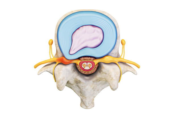 überlegene ansicht des menschlichen lendenwirbels mit bandscheibenvorfall und rückenmark, isoliert auf weißem hintergrund mit copy space 3d-rendering-illustration. anatomie, medizin, backbone-pathologie-konzepte. - vertebral body stock-fotos und bilder