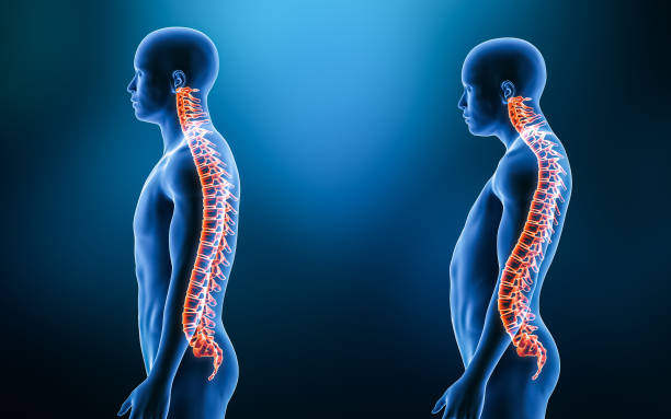 横ビュー 3d レンダリングのイラストレーションから脊椎の正常なバックボーンと lordosis の湾曲と人モデルとの比較。ヒト解剖学、脊髄障害または変形、骨格病理、医療概念。 - human spine posture back backache ストックフォトと画像