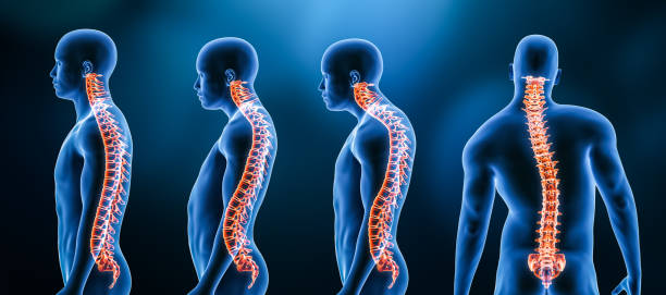 three main curvatures of the spine disorders or deformities on male body: lordosis, kyphosis and scoliosis 3d rendering illustration. human anatomy, back injury or disease, medical concepts. - human spine posture back backache imagens e fotografias de stock