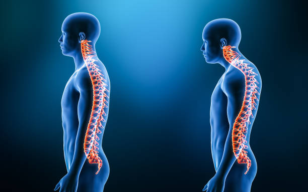 Comparison between normal curvature of the spine and kyphosis with male model from lateral view 3D rendering illustration. Human anatomy, spinal disorders or deformity, backbone pathology, medical concepts. stock photo